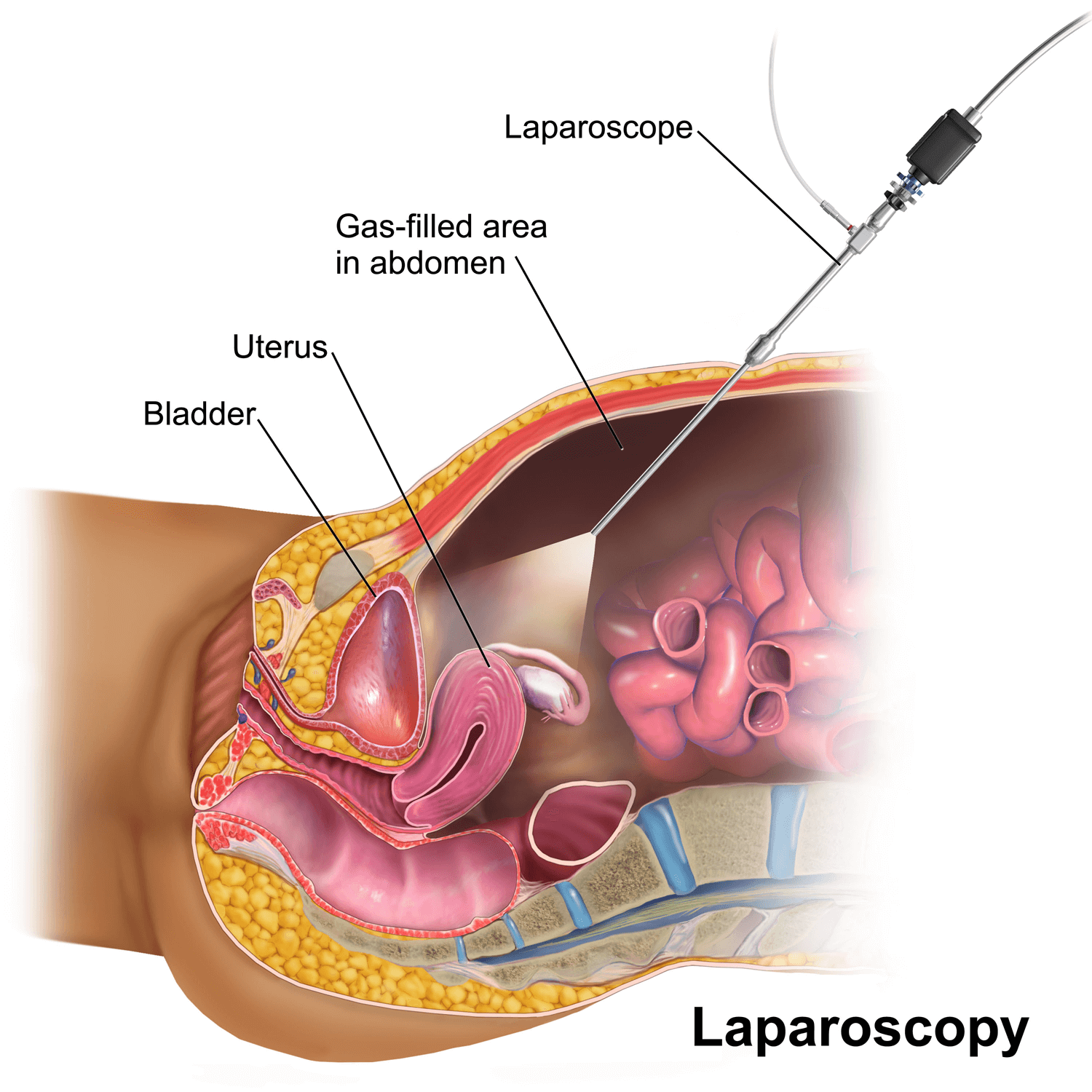 Laparoscopic-hernia-dubai